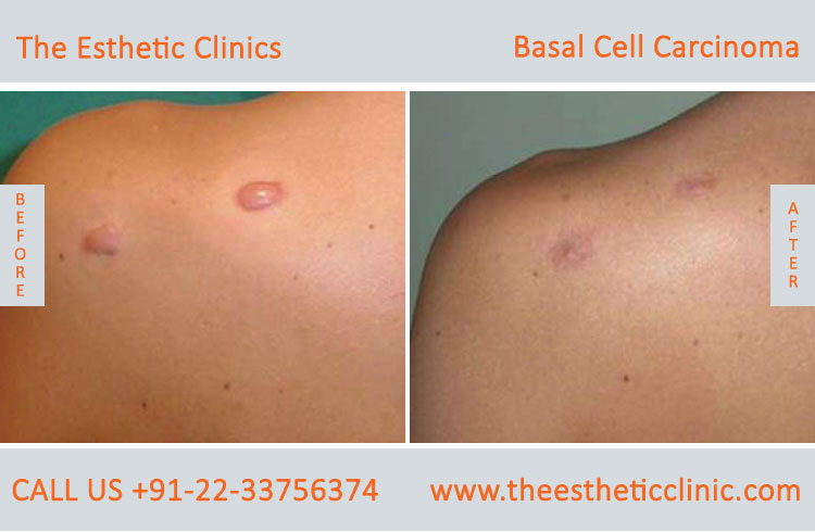 Basal Cell Carcinoma Treatment Surgery before after photos in mumbai india (5)